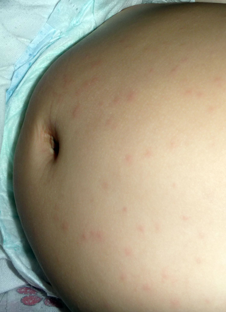 Are Meningitis Spots Raised