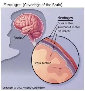 Bacterial Meningitis Brain Damage