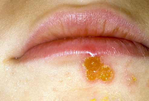 Bacterial Meningitis Rash Images