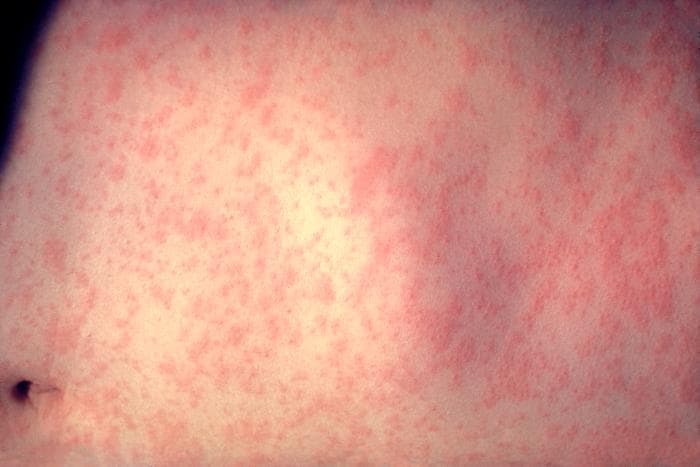 Bacterial Meningitis Rash Images