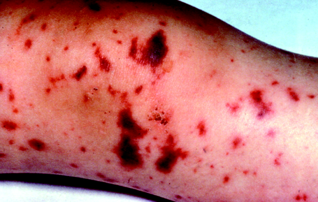Bacterial Meningitis Rash Pictures