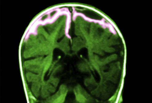 Meningitis Brain Damage Symptoms