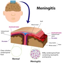 Meningitis Brain Symptoms