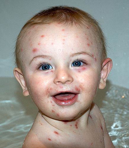 Meningitis Rash Images Babies