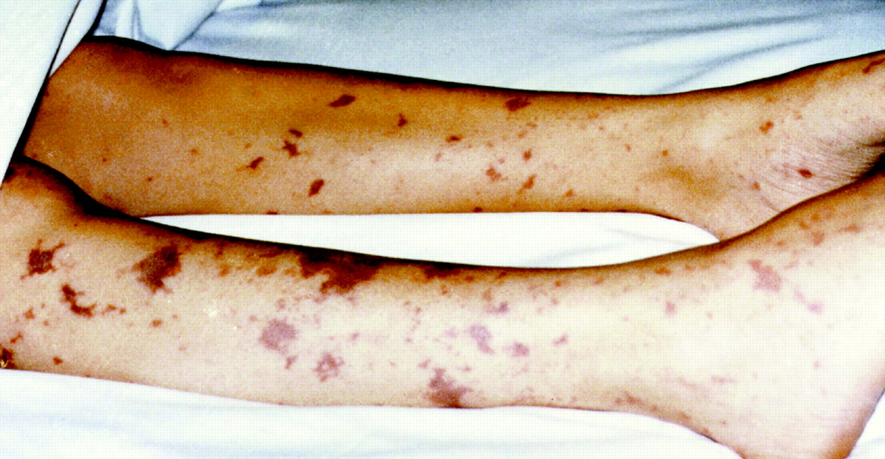 Meningitis Spots Pictures
