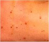 Meningitis Spots Pictures