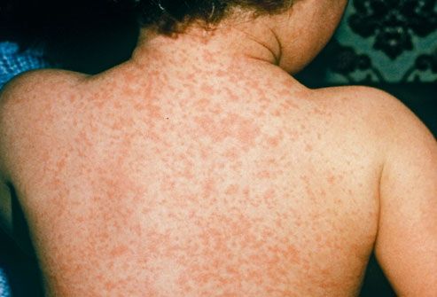 Meningitis Symptoms Adults Rash