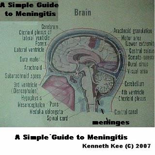 Meningitis Symptoms Adults Stiff Neck