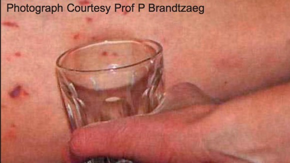 Meningitis Symptoms Rash Glass Test