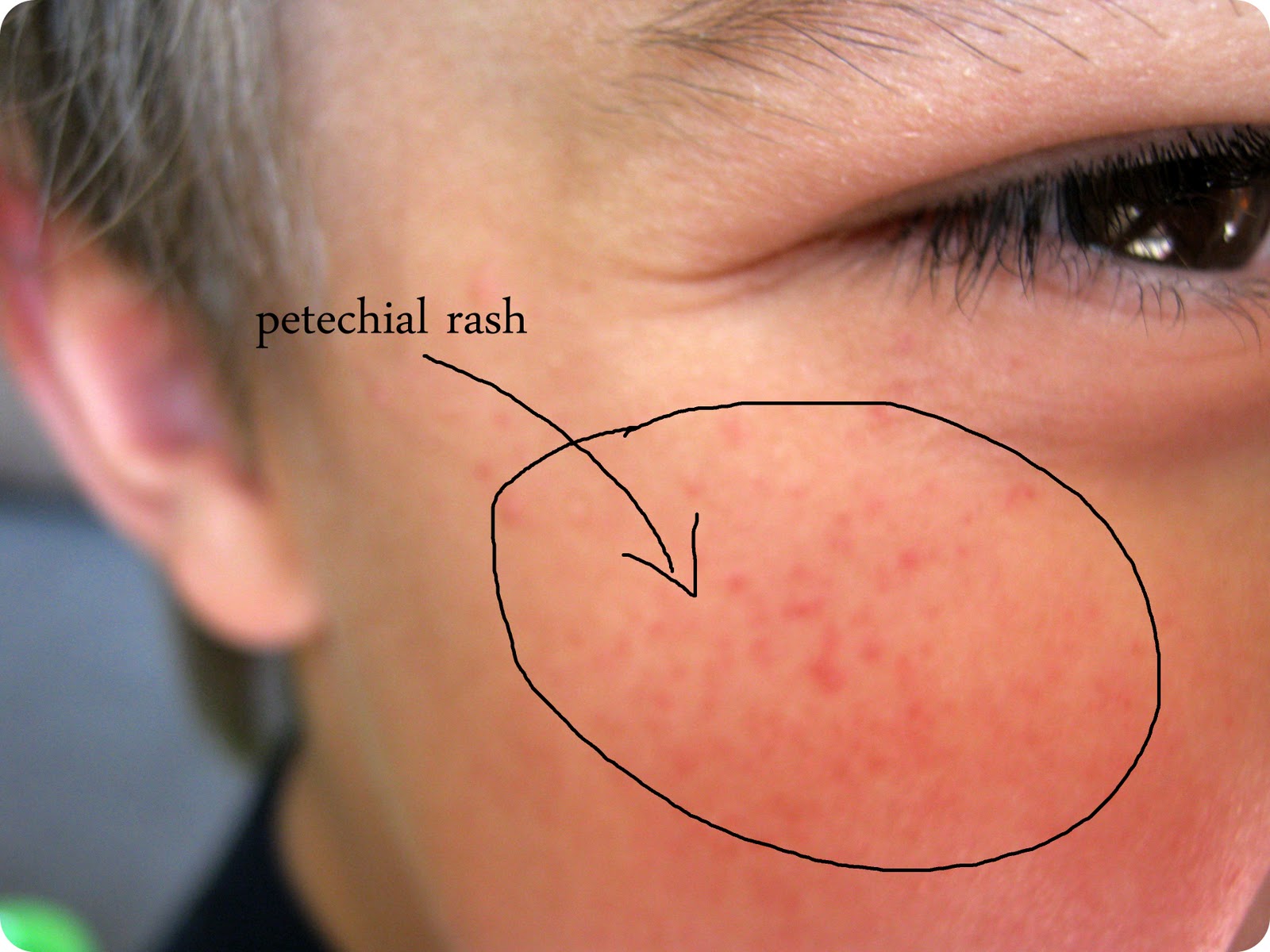 Meningitis Symptoms Rash Pictures