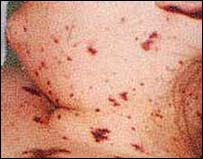 Meningococcal Meningitis Rash Images