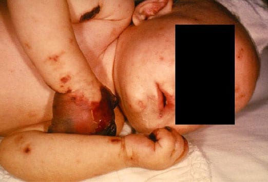 Symptoms Of Meningitis In Children Aged 8