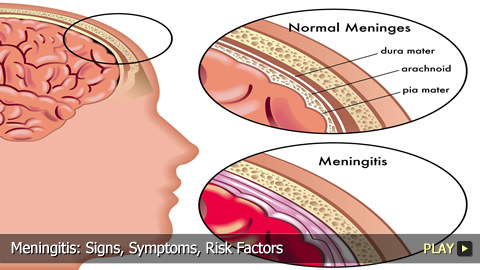 Warning Signs Of Meningitis In Children